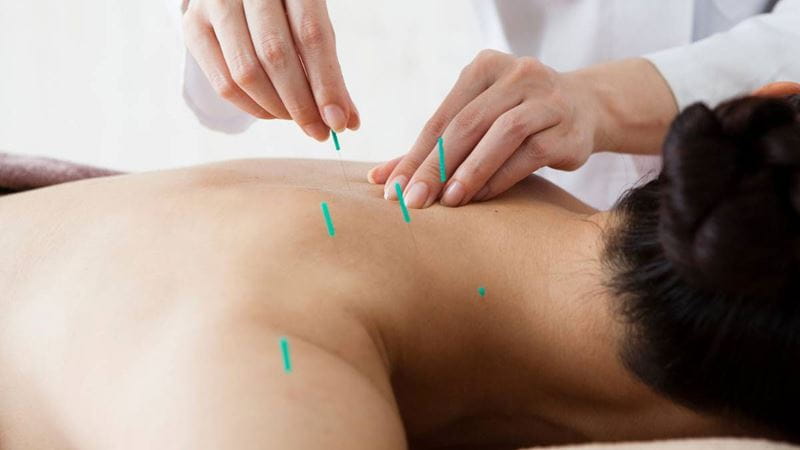 Man getting acupuncture