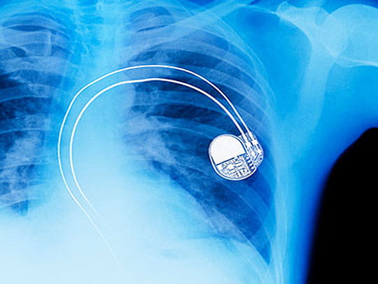 Pacemaker x ray