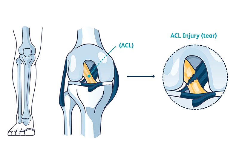 Illustration of anterior cruciate ligament injury
