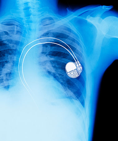 X-ray from pacemaker surgery